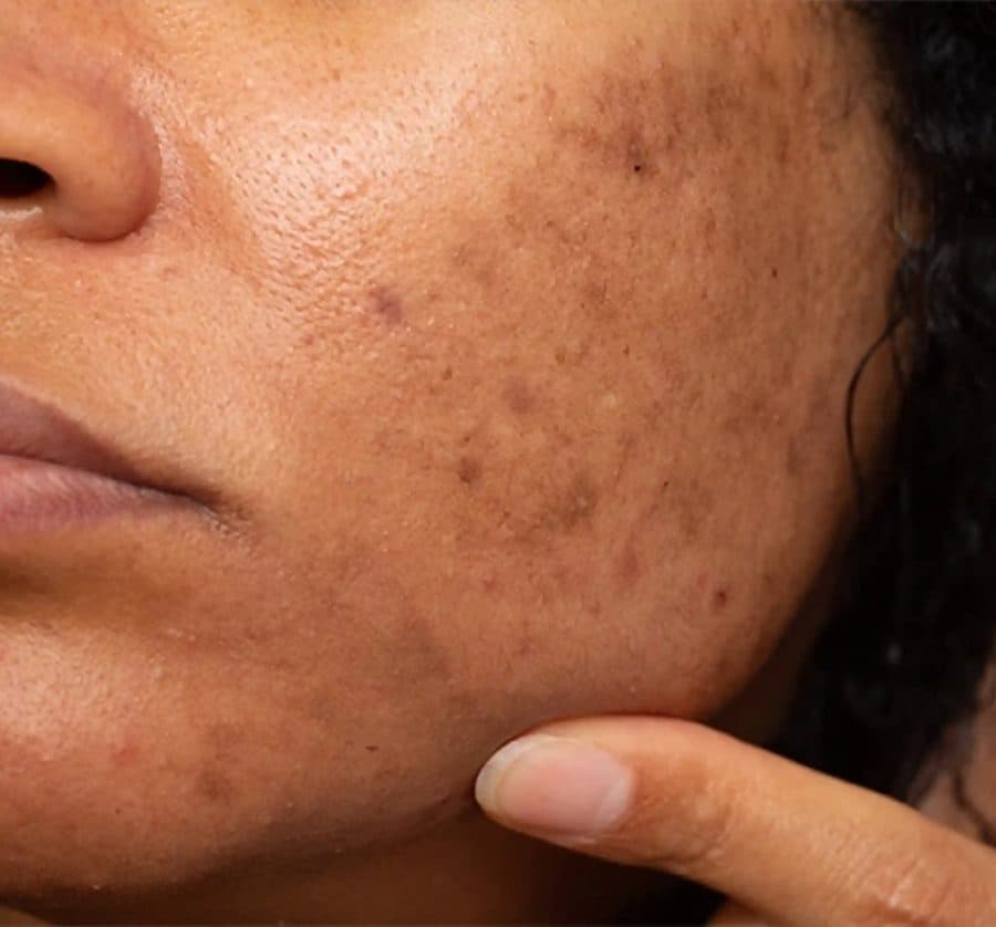 Acne scars or pigmentation