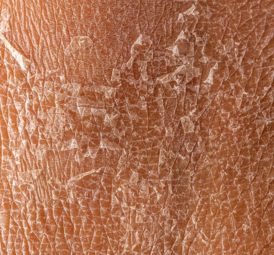 Dry & Flaky Skin